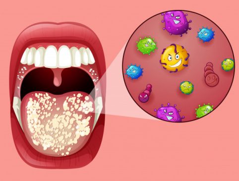 oral thrush