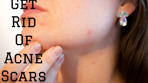 get rid of acne scars